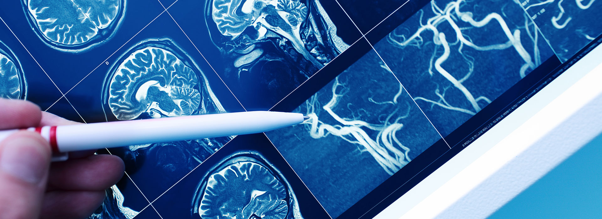 Hand pointing with pen to the brain blood vessel on the MRI image